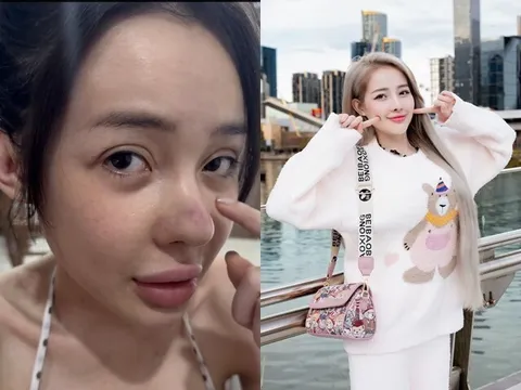 Sau 12 lần phẫu thuật thẩm mỹ rồi bị co rút mũi, Ngân 98 lại tiếp tục "gặp biến" khiến dân tình tá hoả